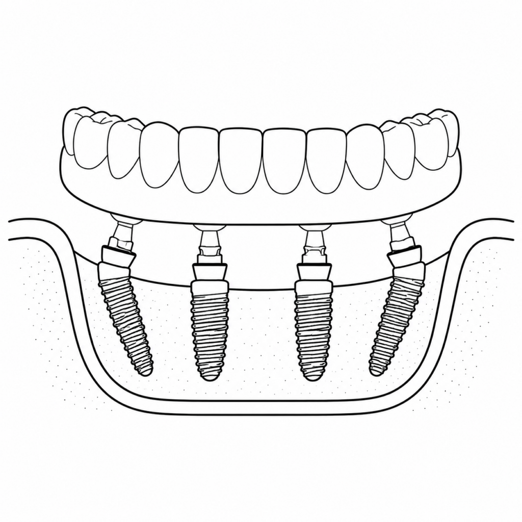 Implantes dentales All on 4