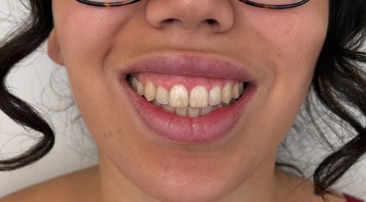 Antes